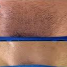 Depilación Zona inferior