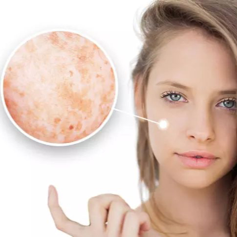 Spots whitening concept - depigmentační kúra