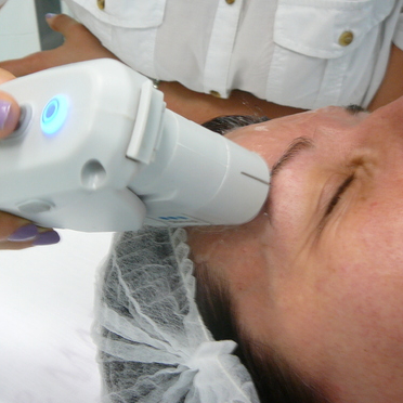 UltheraLIFT celý obličej vč. krku