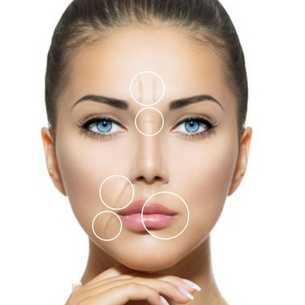 Výplně rtů kyselinou hyaluronovou