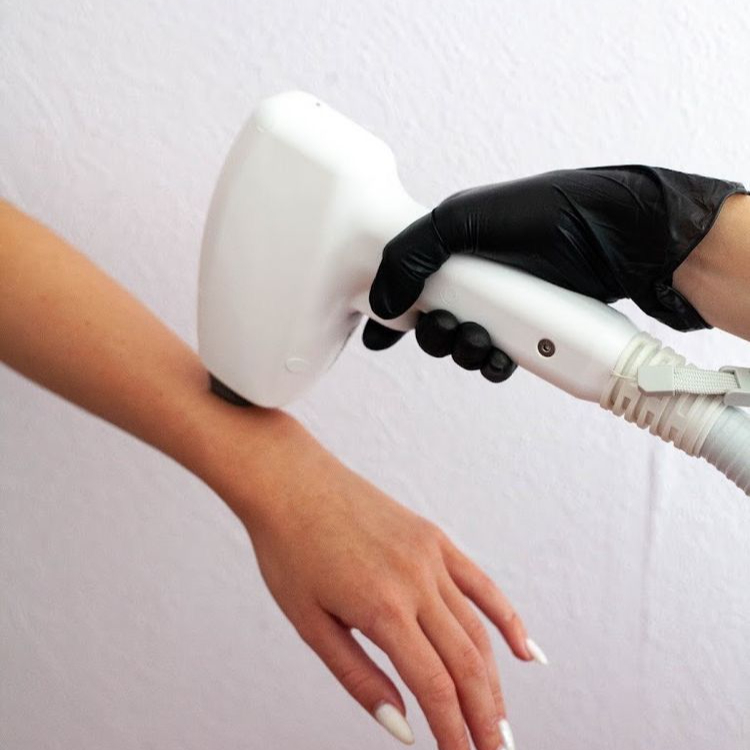 Laserová epilace - malé partie