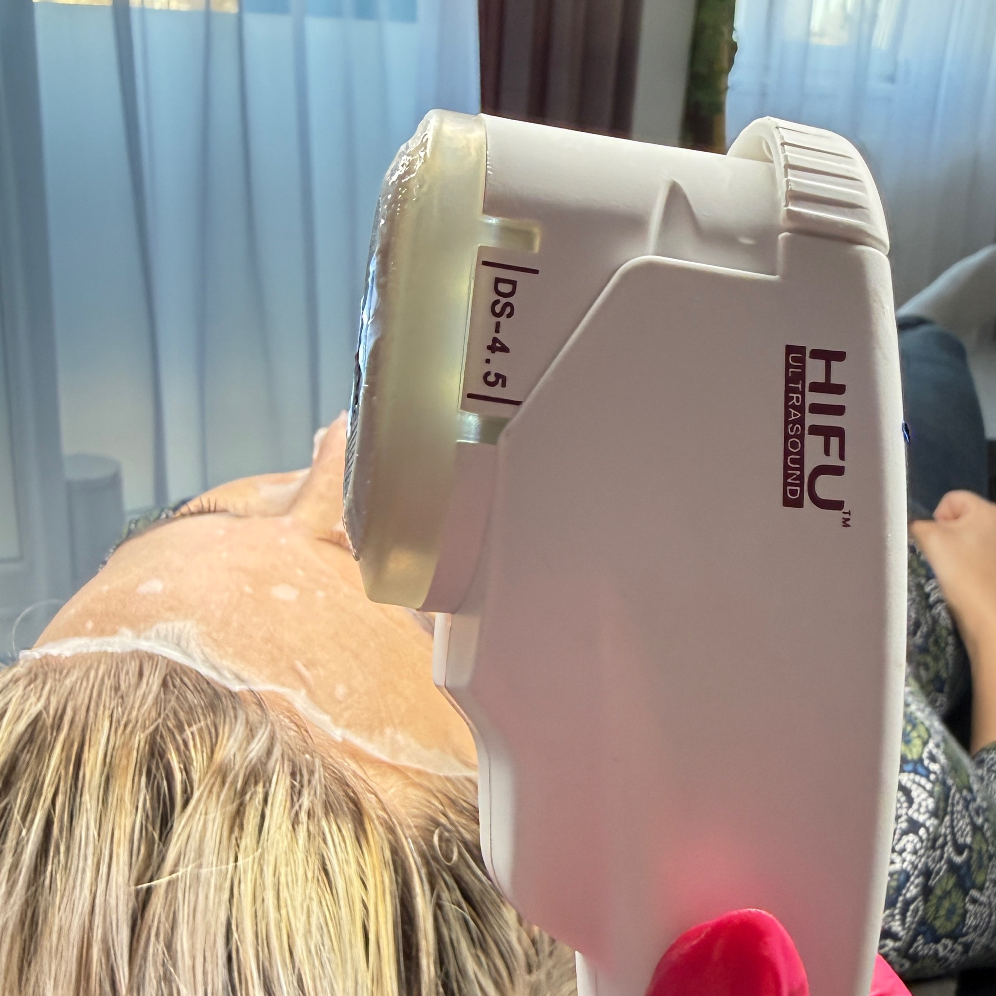 HIFU - Ultralift (dvojitá brada)