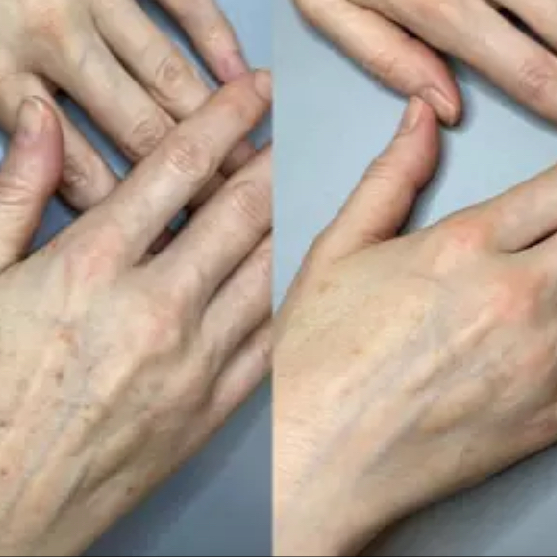 IPL odstranění pigmentace - dlaně