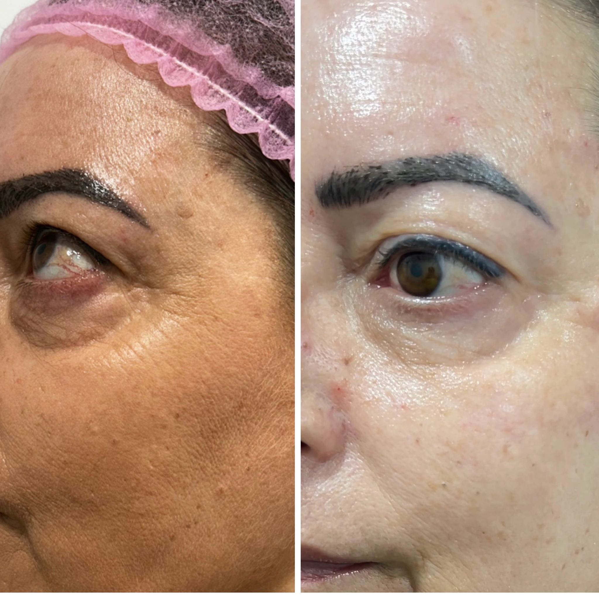 LIFTING FACIAL (ULTRASONIDOS + RF)