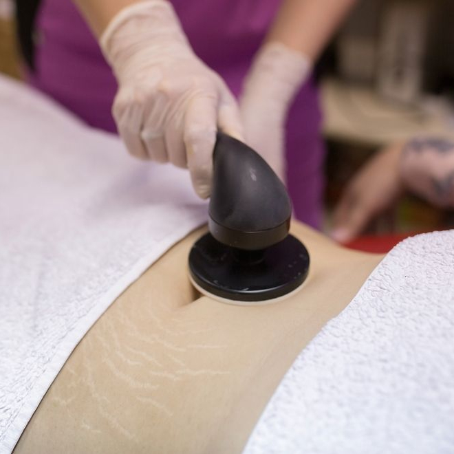 Odstránenie čerstvých strií (45 min)