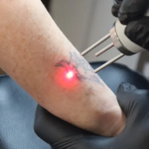 INTAKEGESPREK TATTOO VERWIJDERING