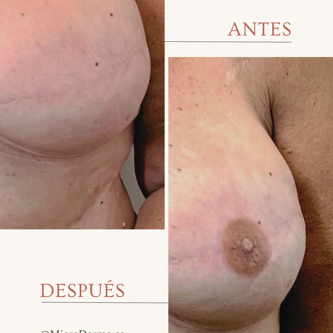 Reconstrucción Areola