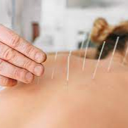 Acupuntura