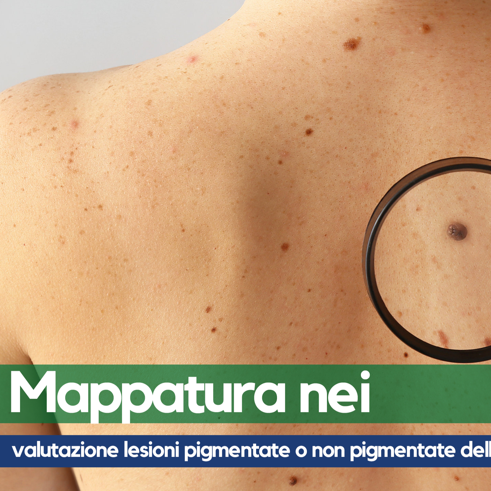 Visita Dermatologica con Epiluminescenza digitale (Mappa Nei)