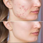 DERMO KOREAN ACNE THERAPY™ – Léčba akné inspirovaná korejskou de