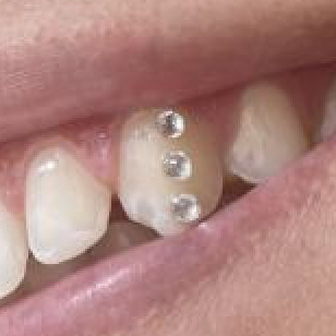 Strass dentaire (3)