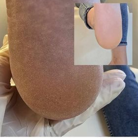 Soins anti callosité