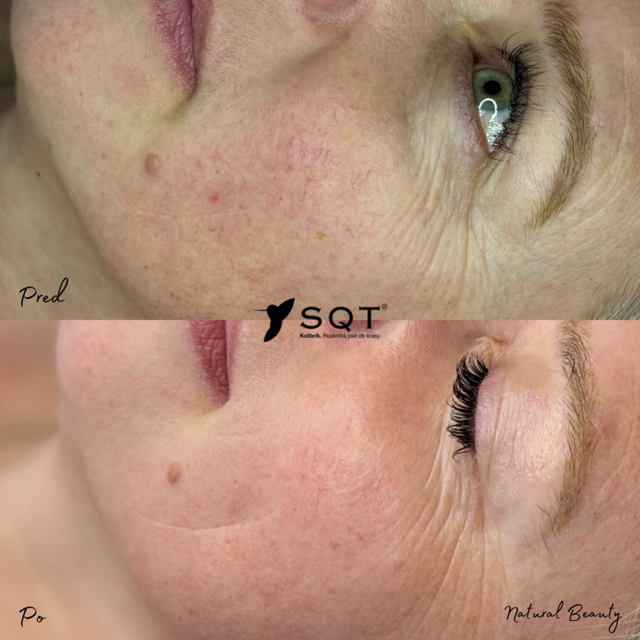 Biomicroneedling