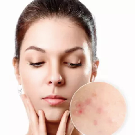 IPL léčba akné, jizvy, červené žilky - obličej