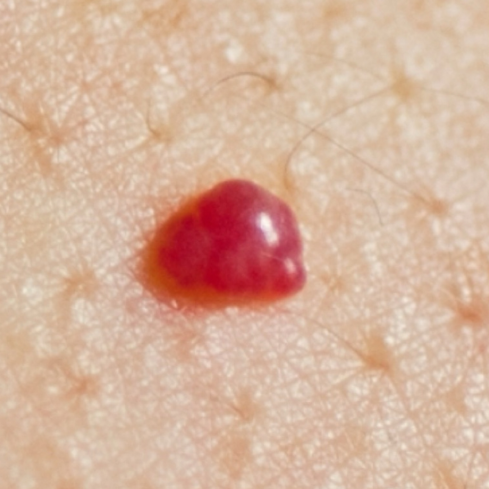 Odstránenie kapilárnych (senilných) hemangiómov elektrokoagulác