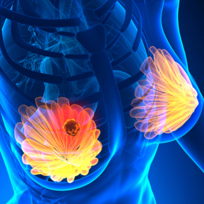 Visita Senologica con Ecografia Mammaria