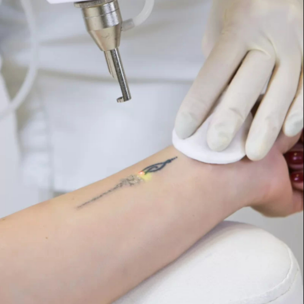 Laser Rimozione Tatuaggi
