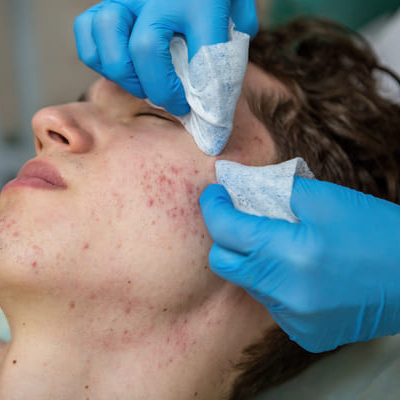 LIMPIEZA FACIAL PROFUNDA