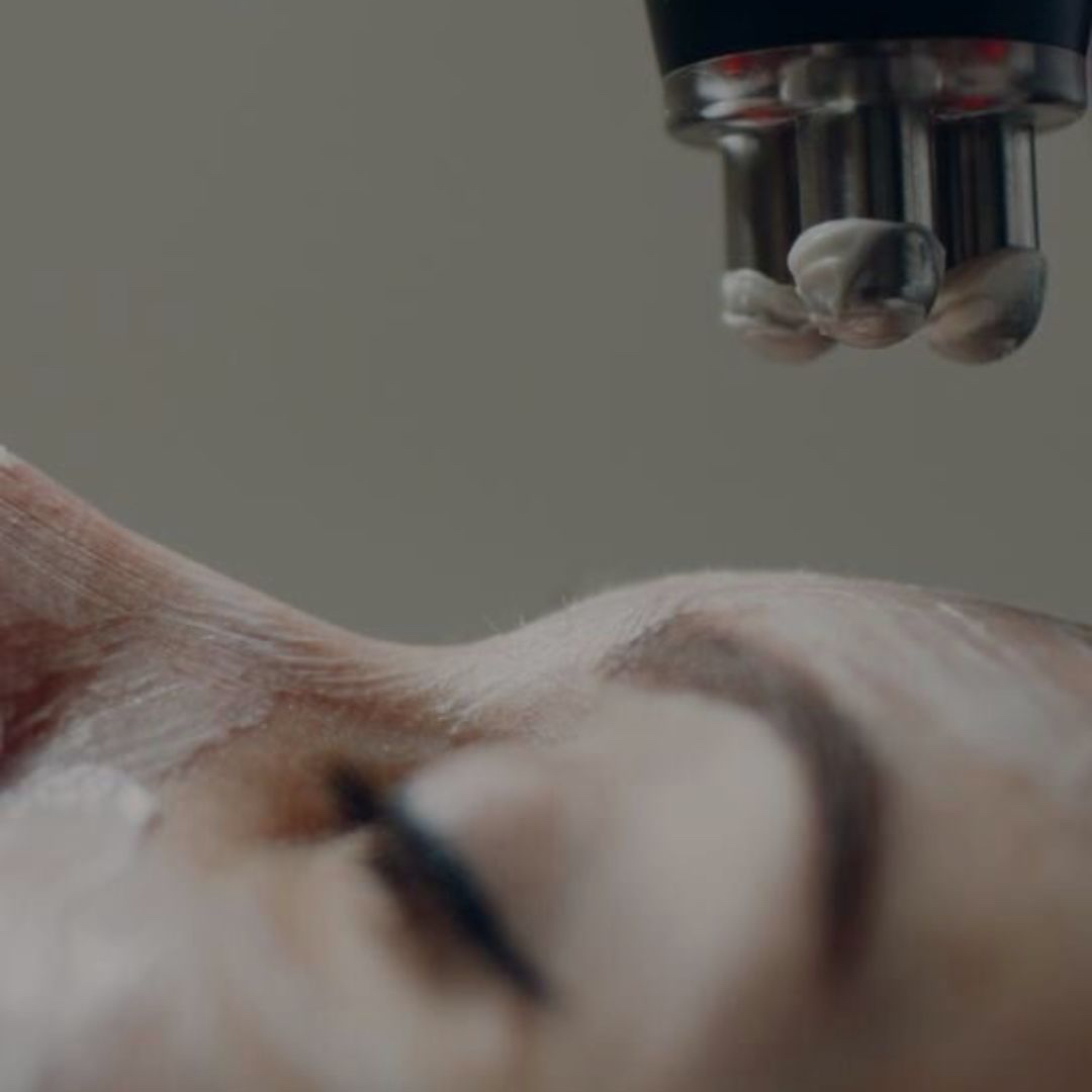 Séance de Radiofréquence visage