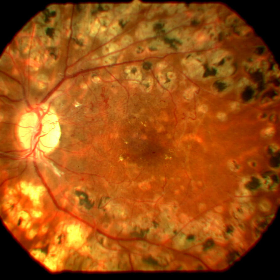 Diabetic Retinopathy Screening