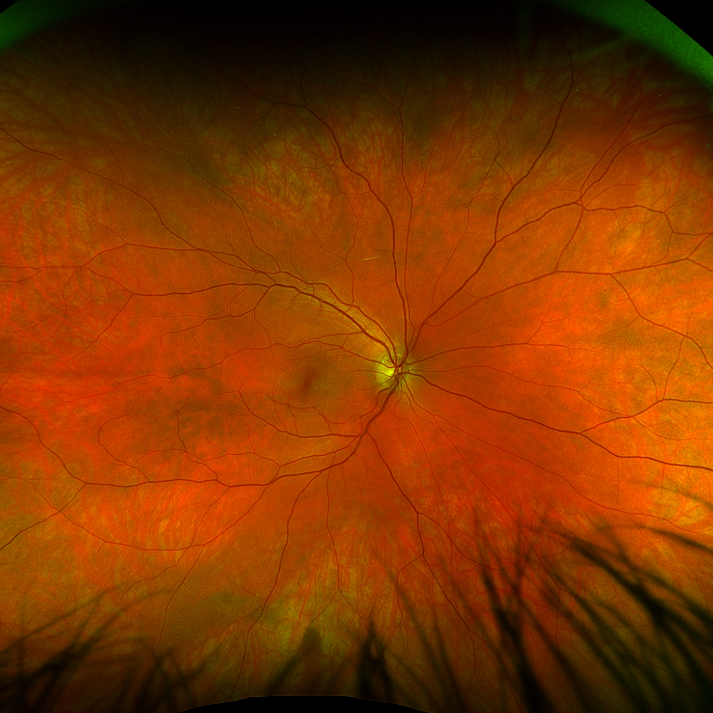 Consultation at The Eye Clinic - RETINA & UVEITIS