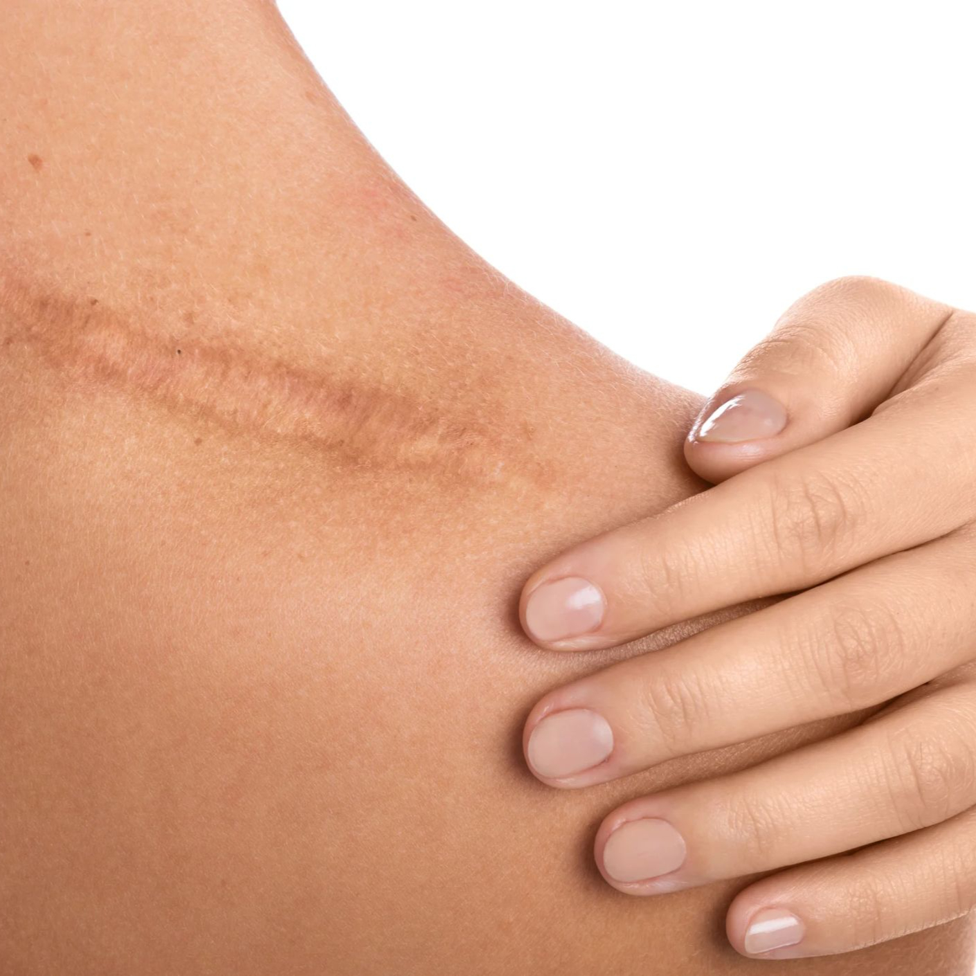 Napětí pramenící z jizev