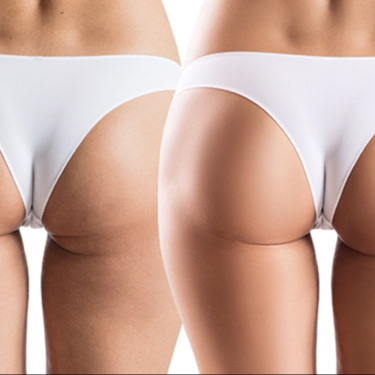 Massage Anti-Cellulite