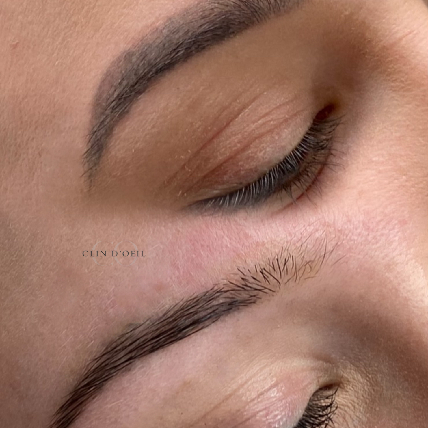 Dépigmentation Flash