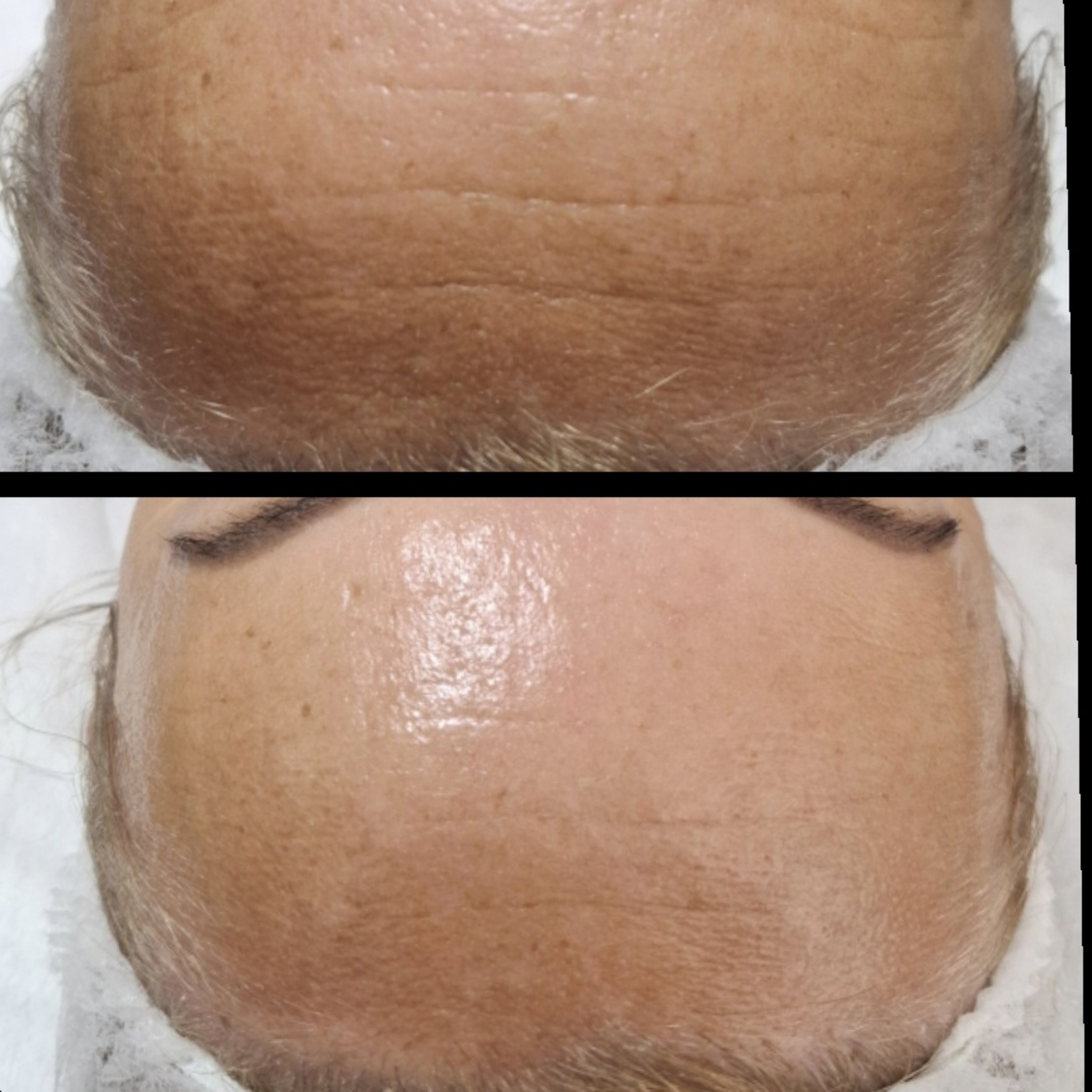 Kosmetika anti-age aktivní peptidy a rozpuštěné kolagenové nitě