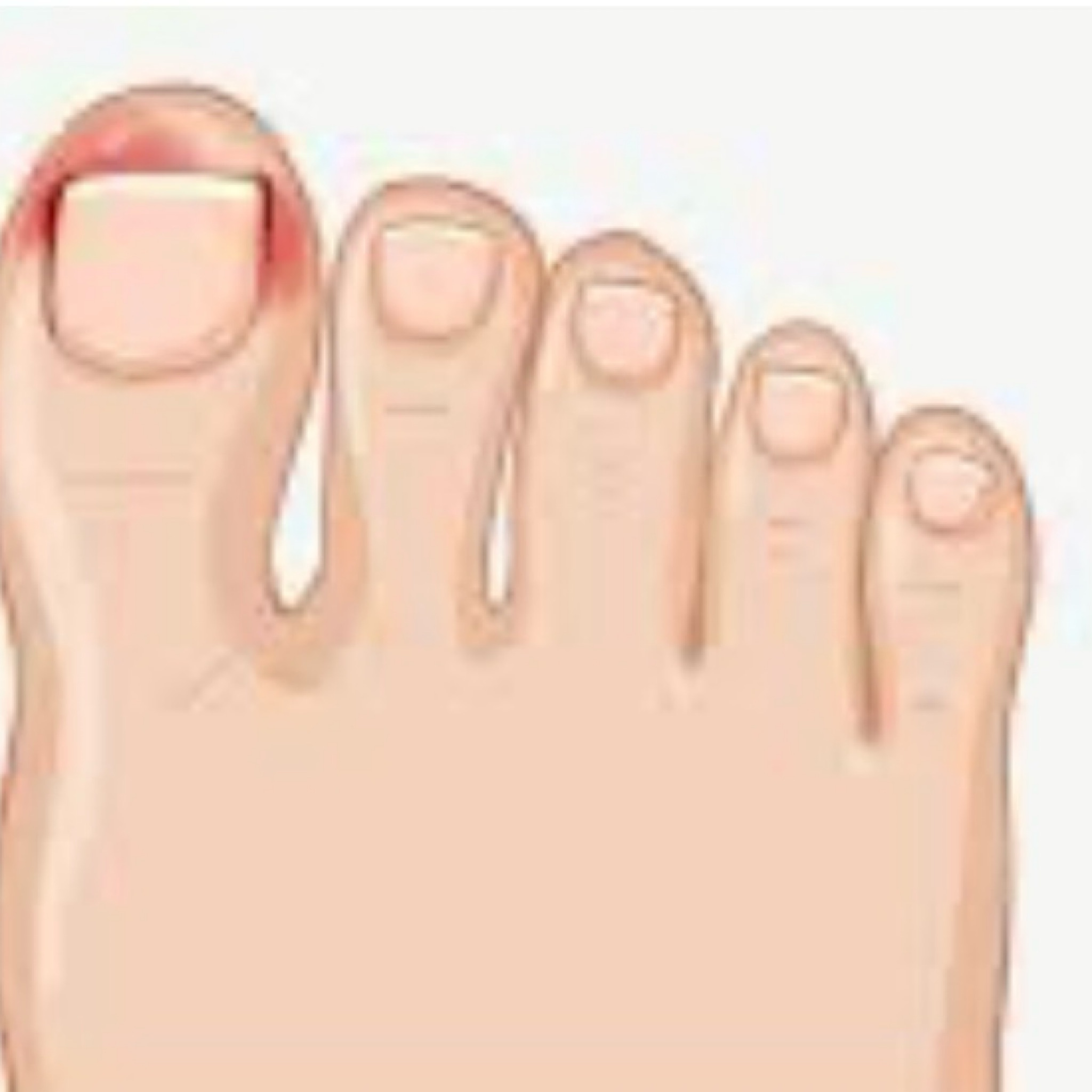 Unhas encravadas que continuam a doer