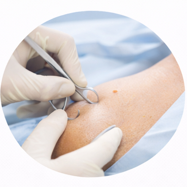 Asportazione piccola cisti/lipoma