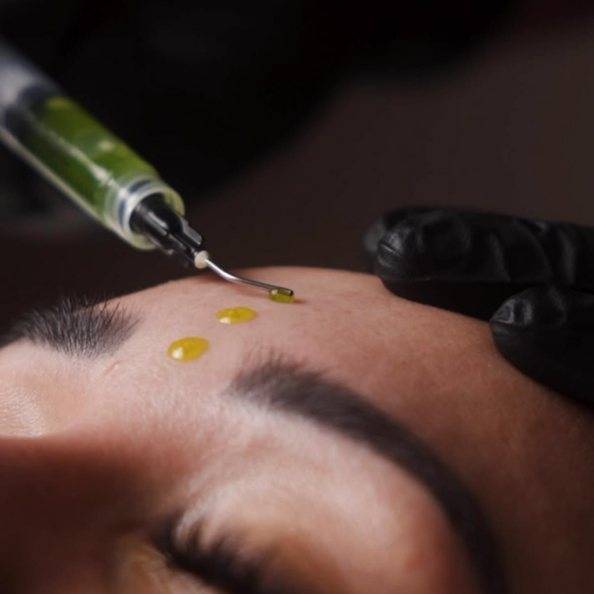 BioRePeelCl₃ - Chemický peeling