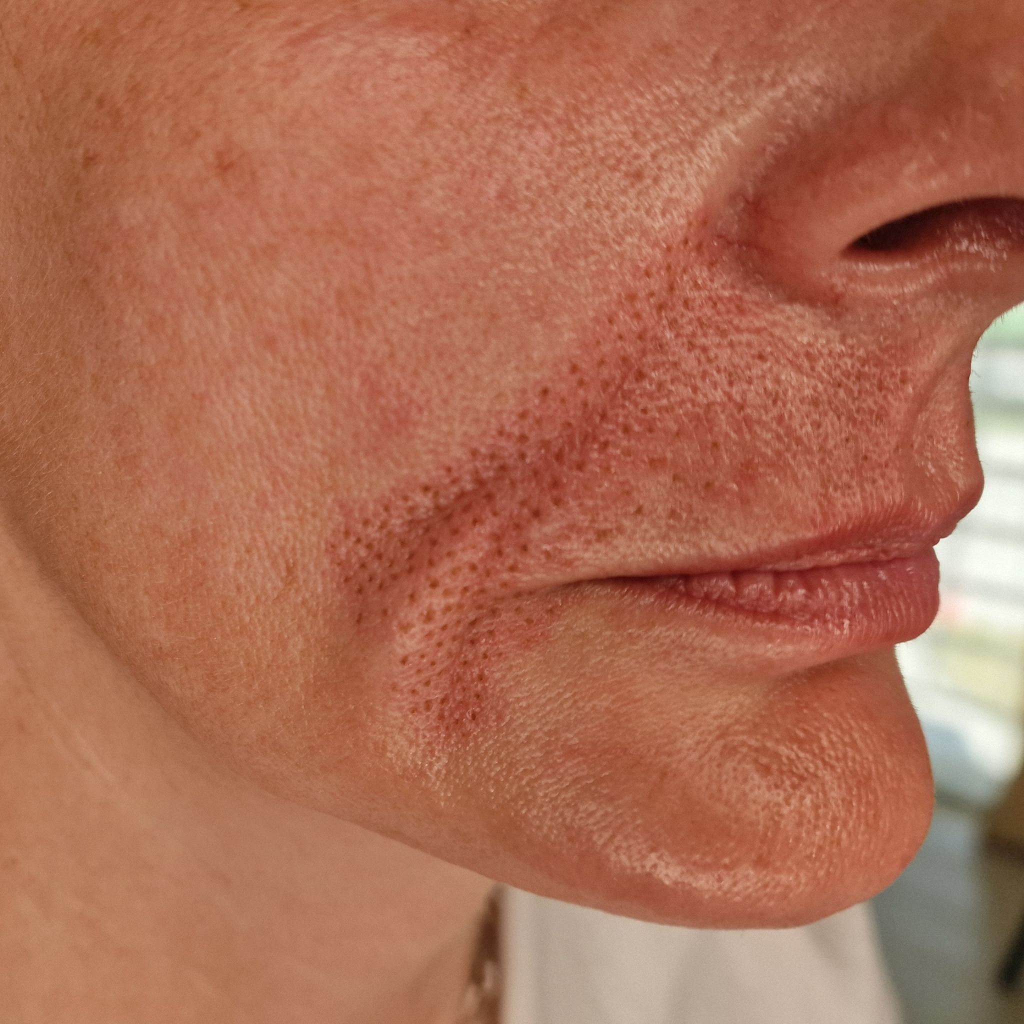 Fibroblastová terapia ( Plasma Pen fibroblast)