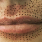 Plasma pen - nosoretní rýhy + ústa