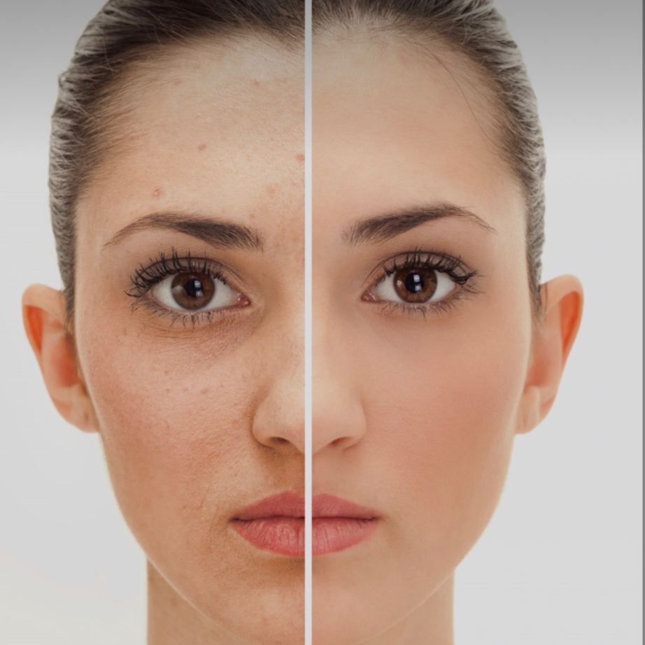 IPL REJUVENECIMIENTO FACIAL