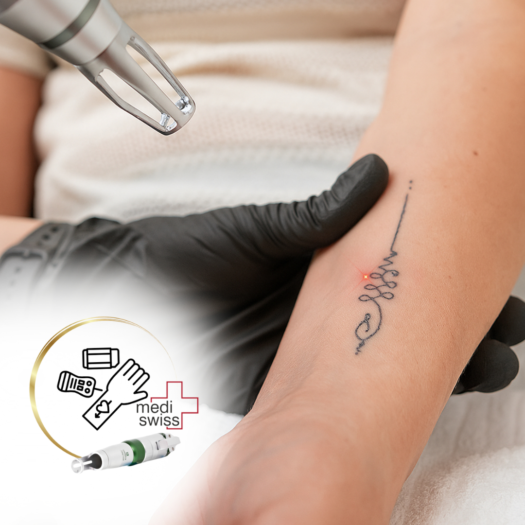 ODSTRANĚNÍ TETOVÁNÍ Laserem - (rozsáhlá tetování 6000+ Kč)