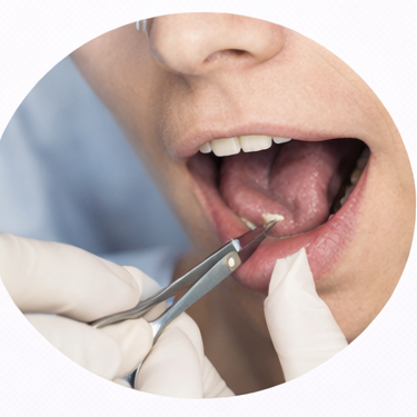 Frenulectomia linguale o labiale