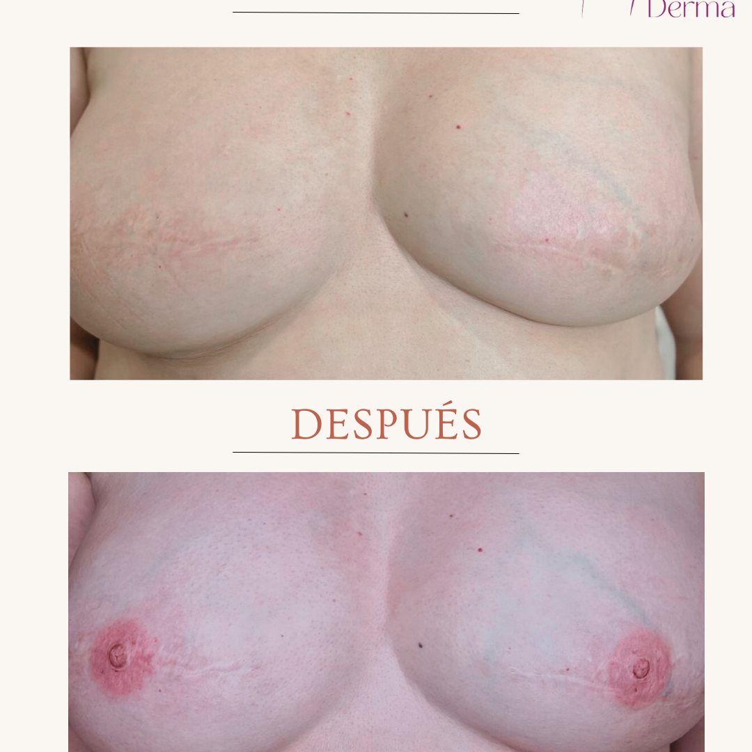 Reconstrucción Areola Bilateral