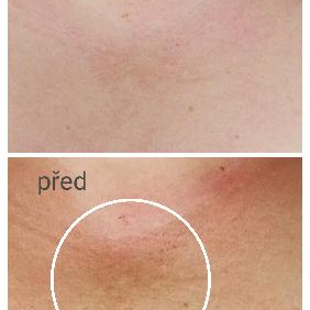 AKCE>podzim/jaro< Profesionální CHEMICKÝ PEELING od 1100,-Kč