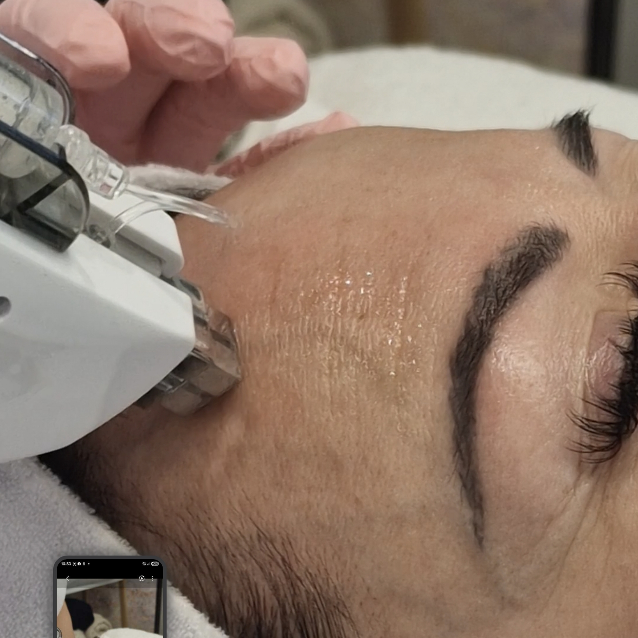 Bezihličková mezoterapia tvár ( prístrojom MESOBOOST)