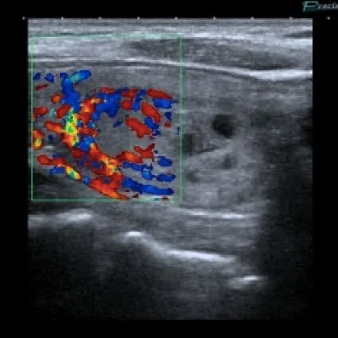 Ecocolordoppler tiroideo
