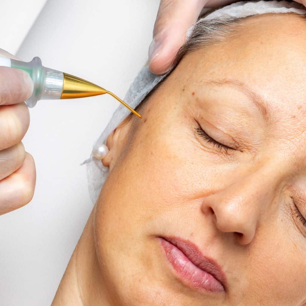 Termikus ionizáció arcfiatalitás