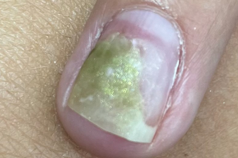 Úprava onychodystrofických (ztluštělých) nehtů