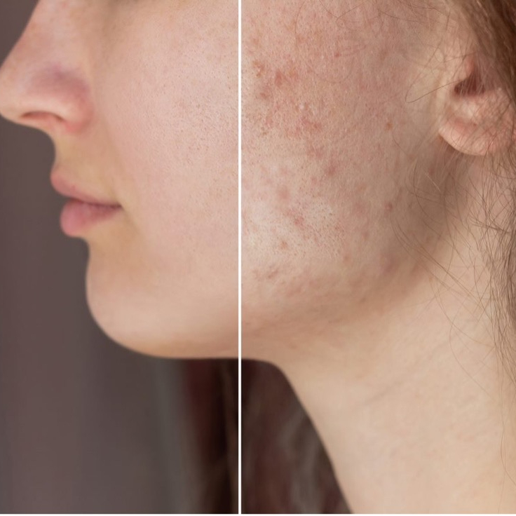 Chemický peeling (korneoterapie)