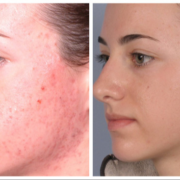 Ošetření problematické pleti