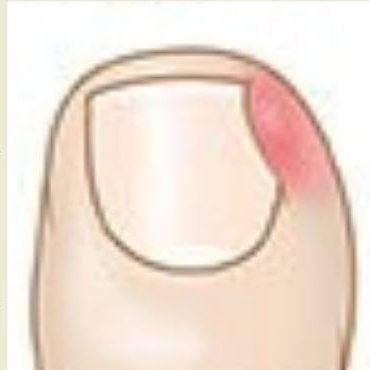 1.pomoc při zárustu nehtu max. 15 min