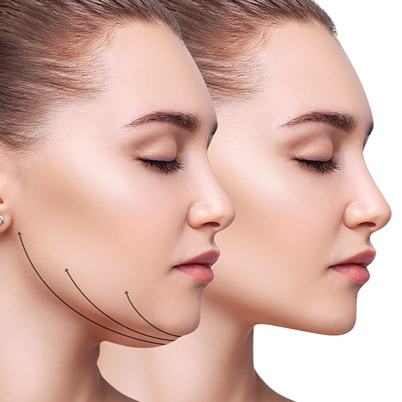 Injekčná lipolýza - Dvojitá brada