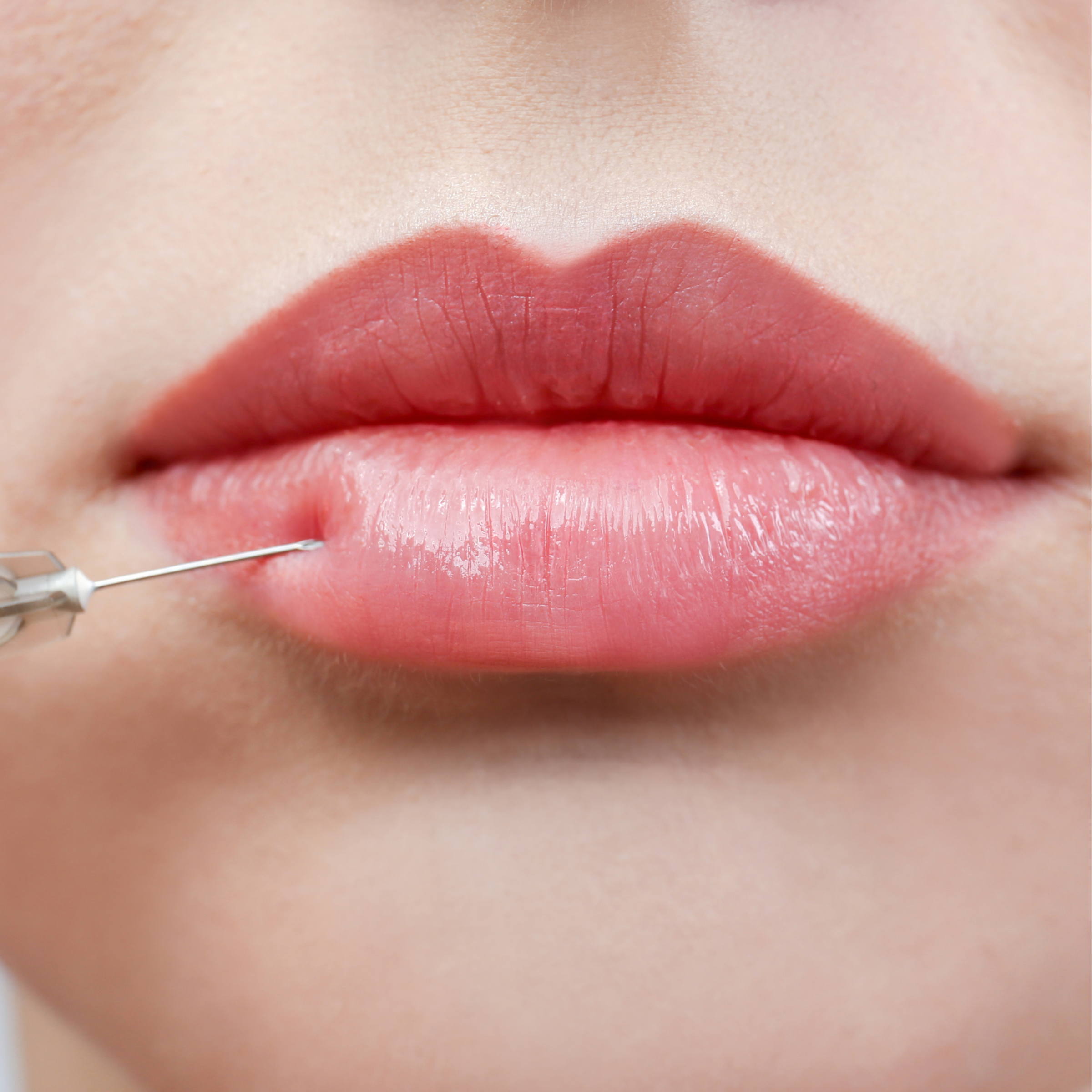 Filler Lippen - lip filler