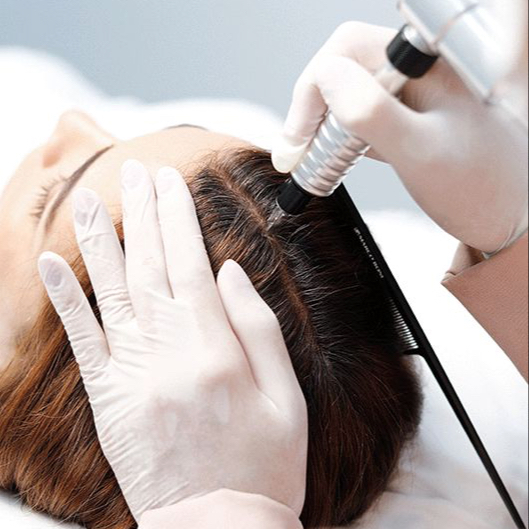 Mikrojehličkování vlasové pokožky(Dermapen)/Scalp microneedling