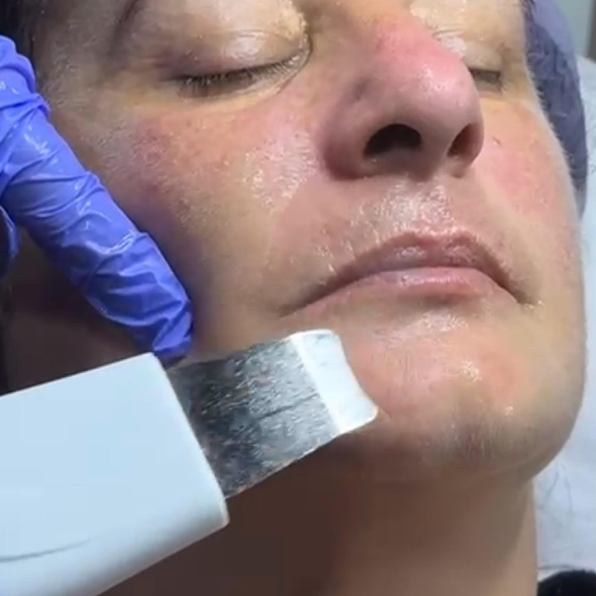 Limpieza facial mixta